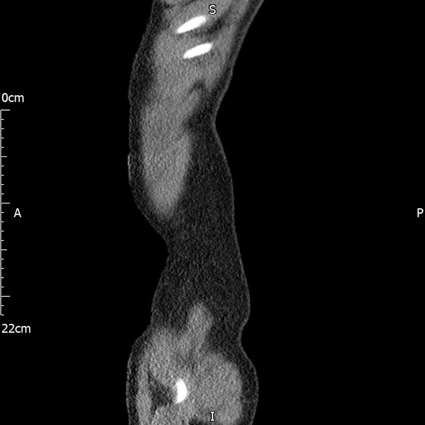 Bilateral medullary nephrocalcinosis with ureteric calculi (Radiopaedia 71269-81569 C 109).jpg