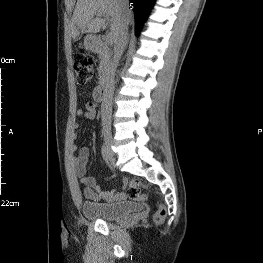 Bilateral medullary nephrocalcinosis with ureteric calculi (Radiopaedia 71269-81569 C 67).jpg