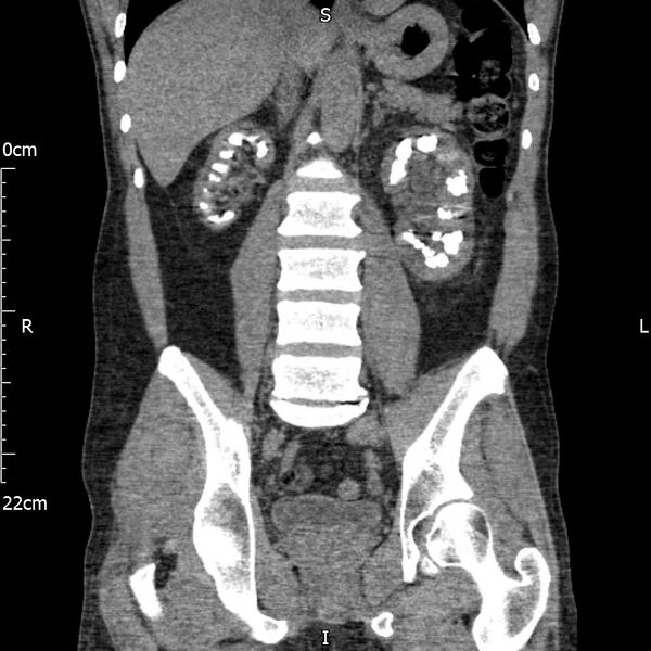 File:Bilateral medullary nephrocalcinosis with ureteric calculi (Radiopaedia 71269-81569 Coronal non-contrast 43).jpg