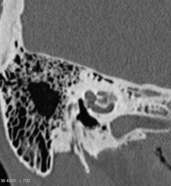 File:Bilateral otosclerosis with left stapes prosthesis (Radiopaedia 5567-7302 Coronal bone window 10).jpg