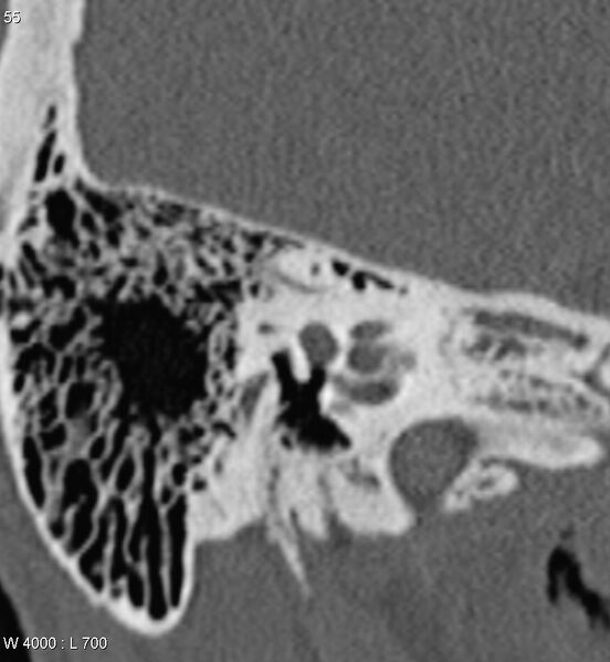 File:Bilateral otosclerosis with left stapes prosthesis (Radiopaedia 5567-7302 Coronal bone window 12).jpg