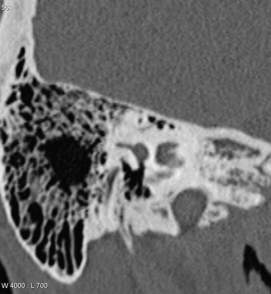 File:Bilateral otosclerosis with left stapes prosthesis (Radiopaedia 5567-7302 Coronal bone window 13).jpg