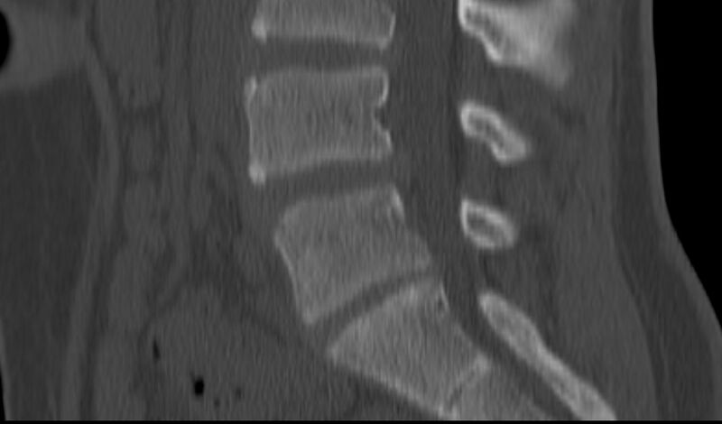 File:Bilateral pars defect (Radiopaedia 26691-26846 Sagittal bone window 33).jpg