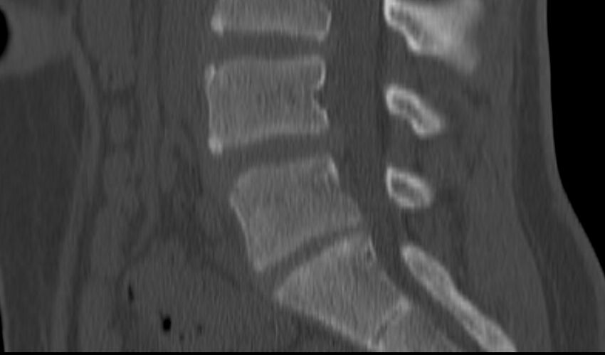 Bilateral pars defect (Radiopaedia 26691-26846 Sagittal bone window 33).jpg