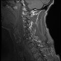 Bilateral perched facets with cord injury (Radiopaedia 45587-49714 Sagittal T1 4).jpg