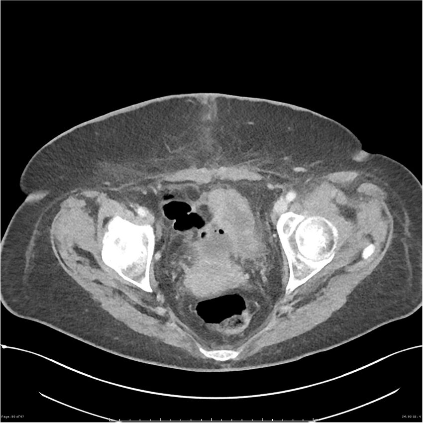 Bilateral psoas hematomas (Radiopaedia 24057-24279 A 80).jpg