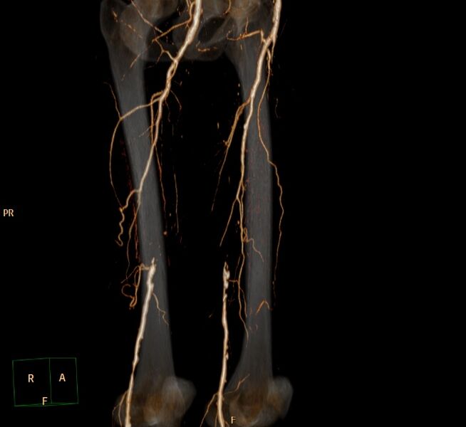 File:Bilateral superficial femoral arterial occlusion (Radiopaedia 25682-25857 3D VR 4).jpg
