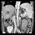 Biliary necrosis - liver transplant (Radiopaedia 21876-21846 C 29).jpg