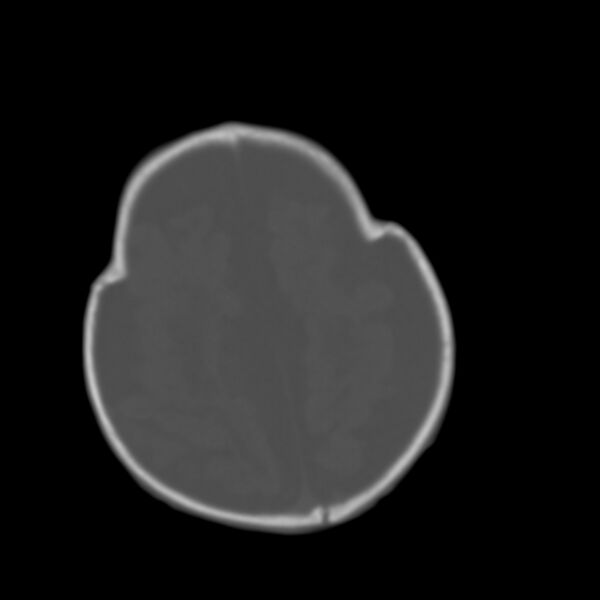 File:Brachycephaly (bi-coronal and bi-lambdoid synostosis) (Radiopaedia 55048-61413 Axial bone window 19).jpg