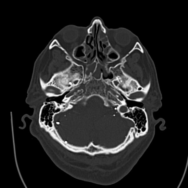 File:Brain Pantopaque remnants (Radiopaedia 78403-91048 Axial bone window 20).jpg