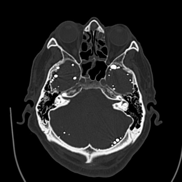 File:Brain Pantopaque remnants (Radiopaedia 78403-91048 Axial bone window 23).jpg