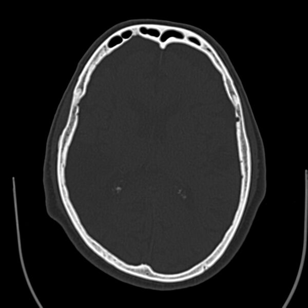 File:Brain Pantopaque remnants (Radiopaedia 78403-91048 Axial bone window 40).jpg