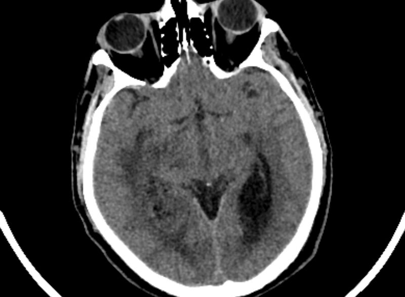 File:Brain abscess complicated by intraventricular rupture and ventriculitis (Radiopaedia 82434-96575 Axial non-contrast 27).jpg