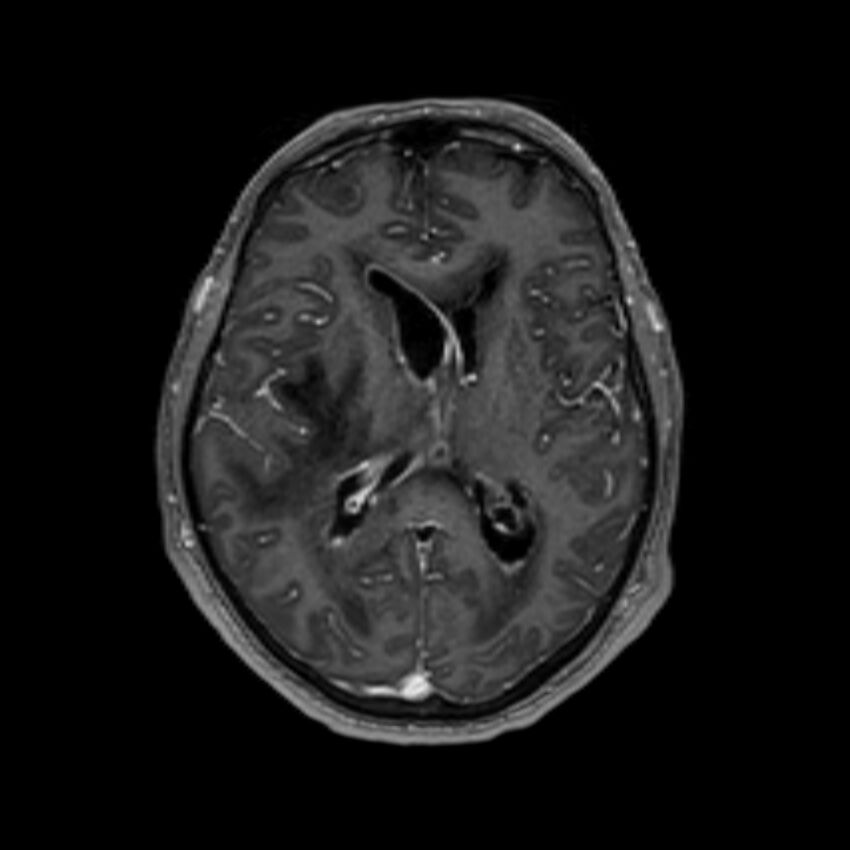 Brain abscess complicated by intraventricular rupture and ventriculitis (Radiopaedia 82434-96577 Axial T1 C+ 37).jpg