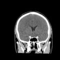 Brain death (Radiopaedia 78597-91360 Coronal non-contrast 31).jpg