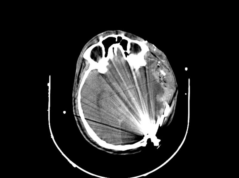 File:Brain injury by firearm projectile (Radiopaedia 82068-96087 B 93).jpg