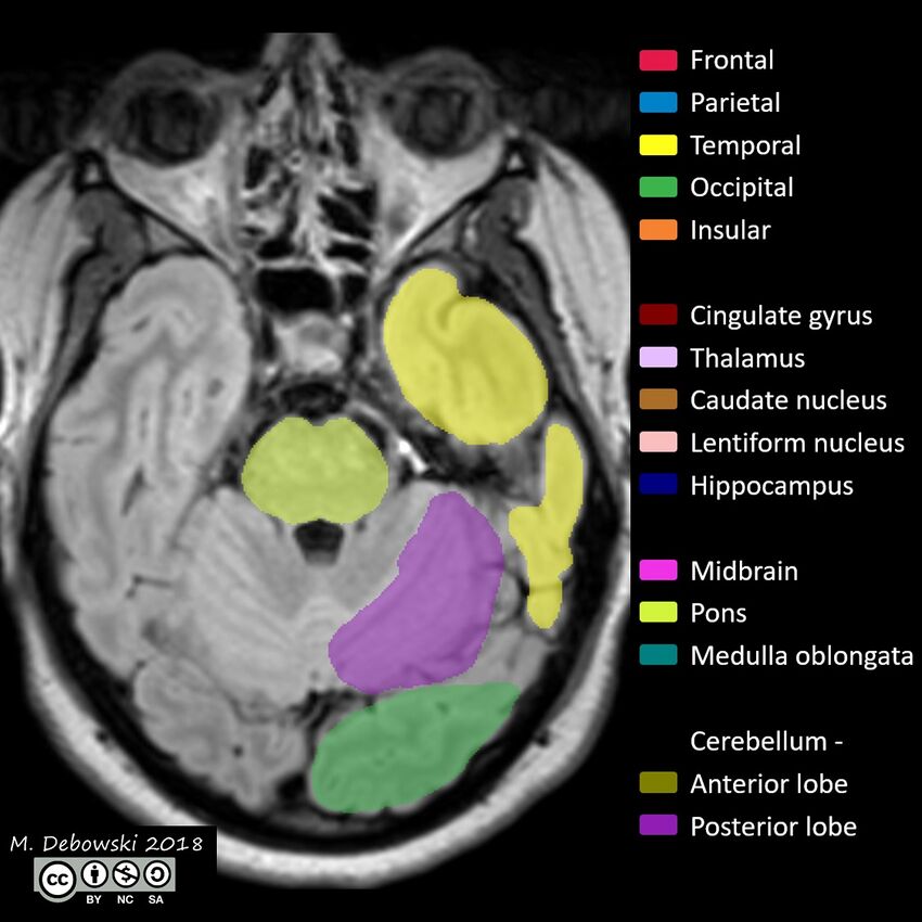 Brain lobes - annotated MRI (Radiopaedia 61691-69700 Axial 56).JPG