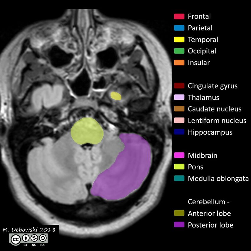 Brain lobes - annotated MRI (Radiopaedia 61691-69700 Axial 62).JPG