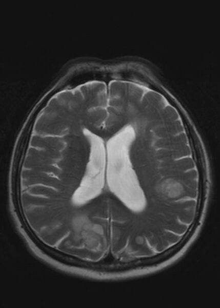 File:Brain metastases from squamocellular lung cancer (Radiopaedia 56515-63222 Axial T2 16).jpg