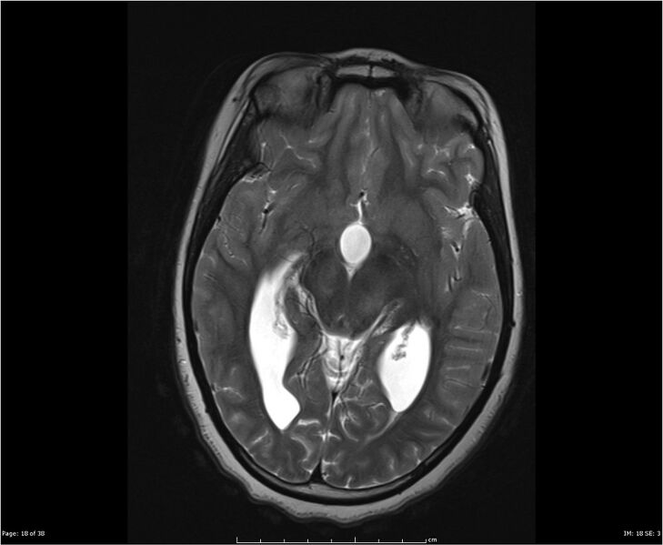 File:Brainstem glioma (Radiopaedia 21819-21775 Axial T2 18).jpg