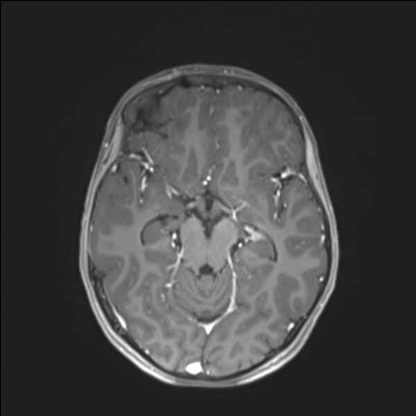 File:Brainstem glioma (Radiopaedia 70548-80674 Axial T1 C+ 69).jpg