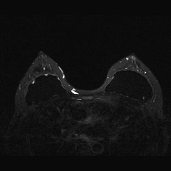 File:Breast implants - MRI (Radiopaedia 26864-27035 T2 SPAIR 31).jpg
