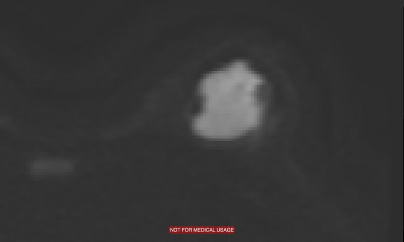 File:Breast lymphoma (MRI) (Radiopaedia 34999-36498 Axial DWI 4).jpg