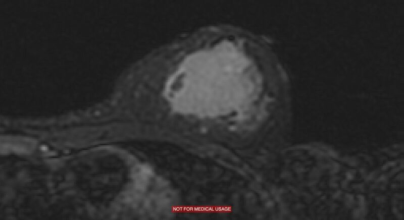File:Breast lymphoma (MRI) (Radiopaedia 34999-36498 Axial STIR 6).jpg