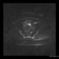 Broad ligament fibroid (Radiopaedia 49135-54241 Axial DWI 17).jpg