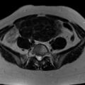 Broad ligament fibroid (Radiopaedia 49135-54241 Axial T2 8).jpg