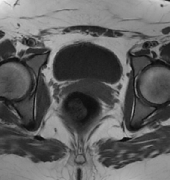 File:Broad ligament leiomyoma (Radiopaedia 81634-95516 Axial T1 20).jpg