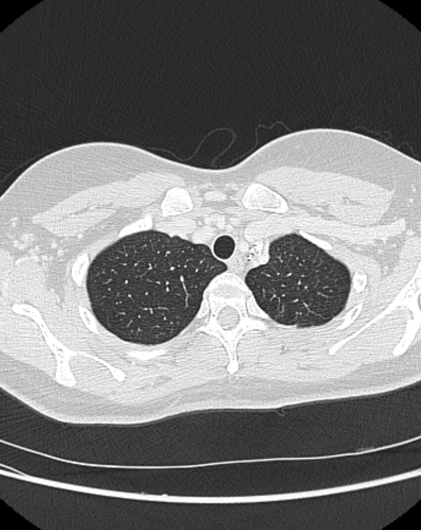 Bronchial atresia (Radiopaedia 50007-55297 Axial lung window 12).jpg