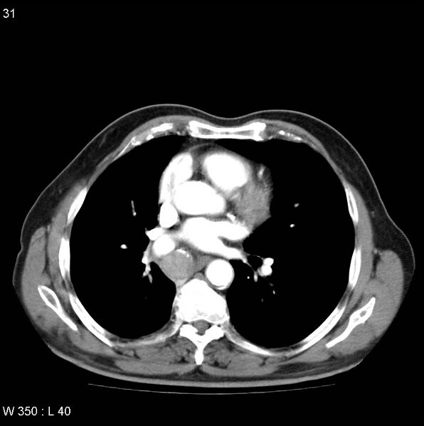 File:Bronchial carcinoid tumor with right lower lobe collapse (Radiopaedia 29060-29422 A 30).jpg
