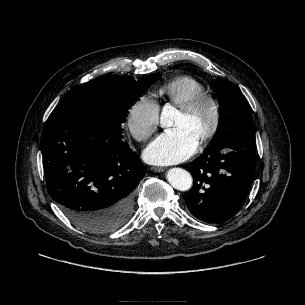 File:Bronchogenic adenocarcinoma and pulmonary embolism (Radiopaedia 9097-9806 D 40).jpg