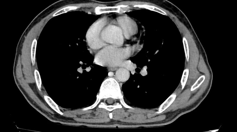 File:Bronchogenic carcinoma with superior vena cava syndrome (Radiopaedia 36497-38054 Axial C+ delayed 59).jpg