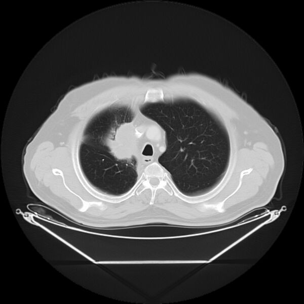 File:Bronchogenic carcinoma with upper lobe collapse (Radiopaedia 29297-29726 Axial lung window 10).jpg