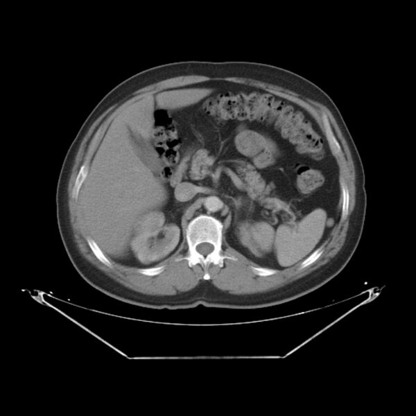 File:Bronchogenic carcinoma with upper lobe collapse (Radiopaedia 29297-29726 C 34).jpg