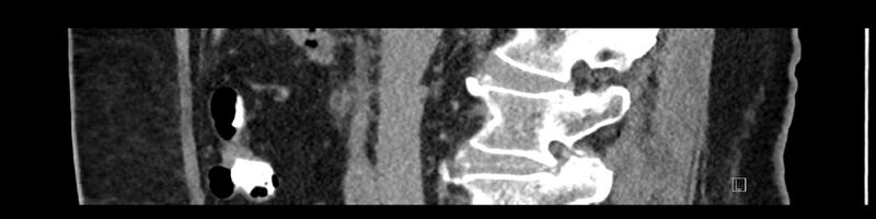 File:Buried bumper syndrome - gastrostomy tube (Radiopaedia 63843-72575 Sagittal Inject 71).jpg