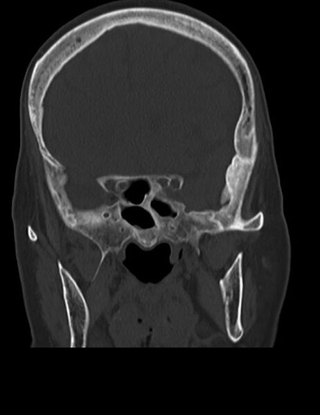 File:Burnt-out meningioma (Radiopaedia 51557-57337 Coronal bone window 19).jpg