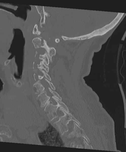 File:C2 fracture with vertebral artery dissection (Radiopaedia 37378-39199 Sagittal bone window 48).png