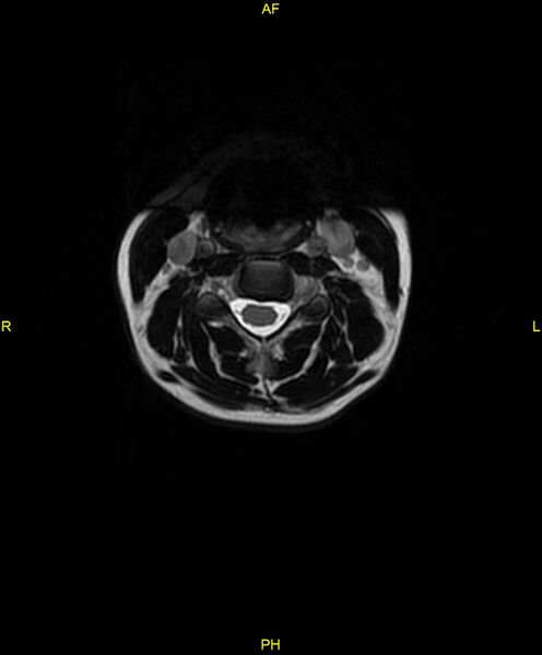 File:C5 nerve sheath tumor (Radiopaedia 85777-101596 Axial T2 23).jpg
