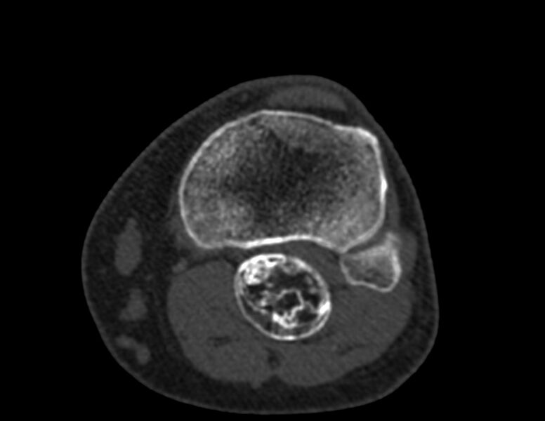 File:Calcified hematoma - popliteal fossa (Radiopaedia 63938-72763 Axial bone window 59).jpg