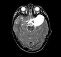 Callosal dysgenesis and ectopic posterior pituitary (Radiopaedia 8382-9213 Axial T2 11).jpg