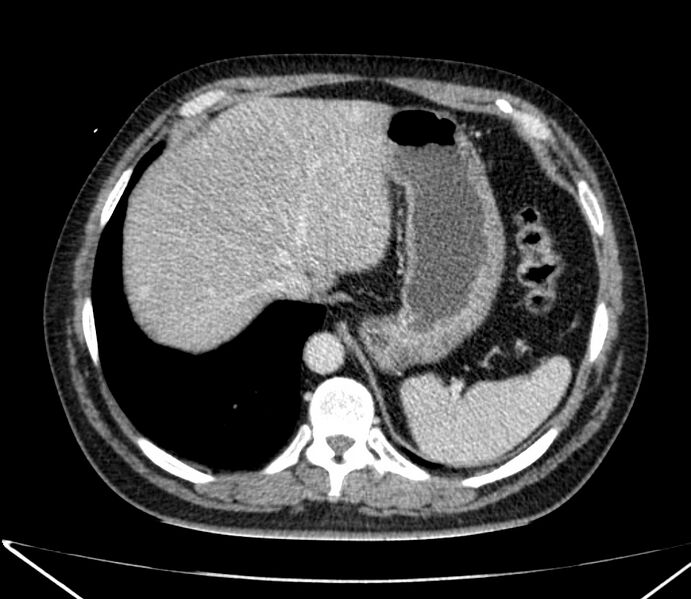File:Carcinoid tumor with hepatic metastases (Radiopaedia 22651-22670 C 32).jpg