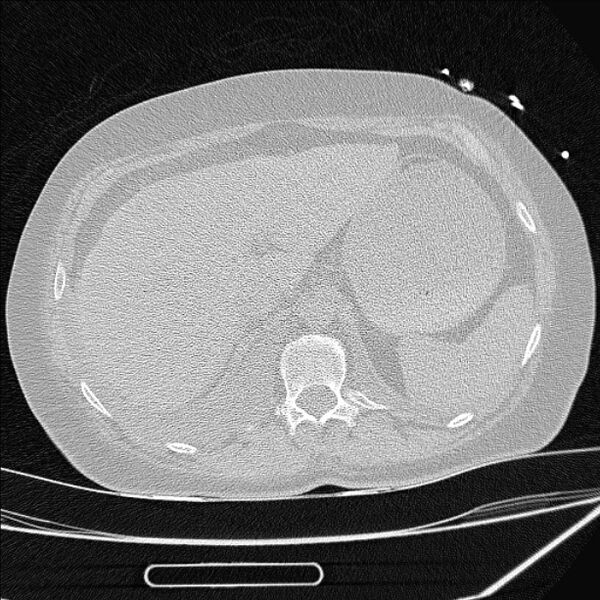 File:Cardiogenic pulmonary edema (Radiopaedia 29213-29609 Axial lung window 104).jpg