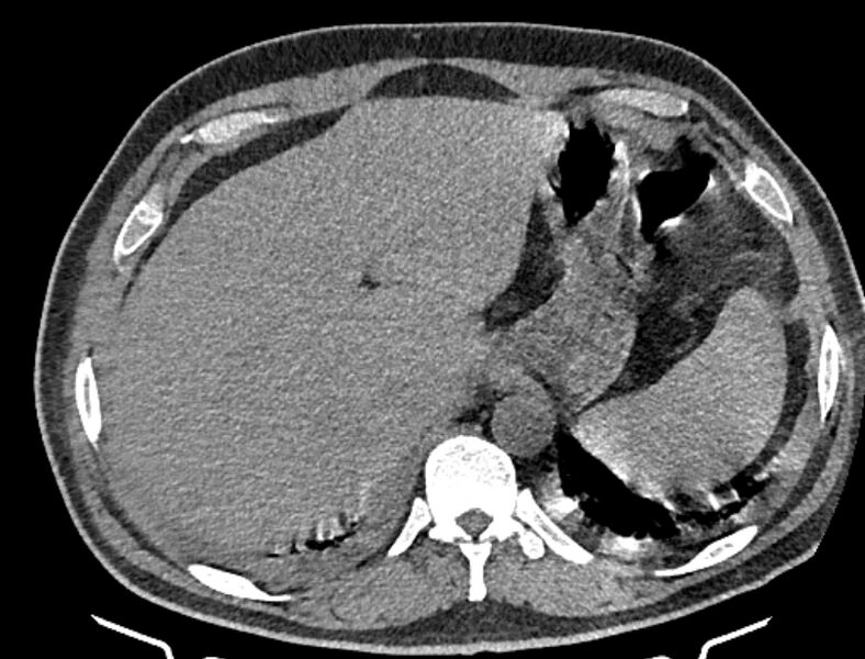 File:Cardiogenic pulmonary edema (Radiopaedia 68180-77678 Axial non-contrast 53).jpg