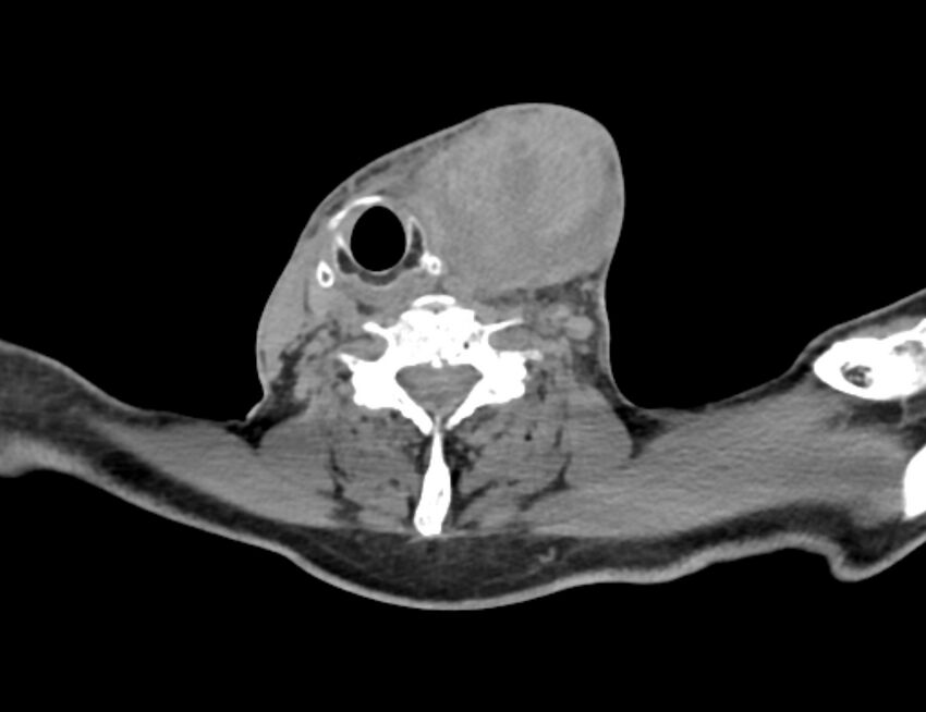 Carotid artery pseudoaneurysm (Radiopaedia 84030-99259 Axial non-contrast 37).jpg