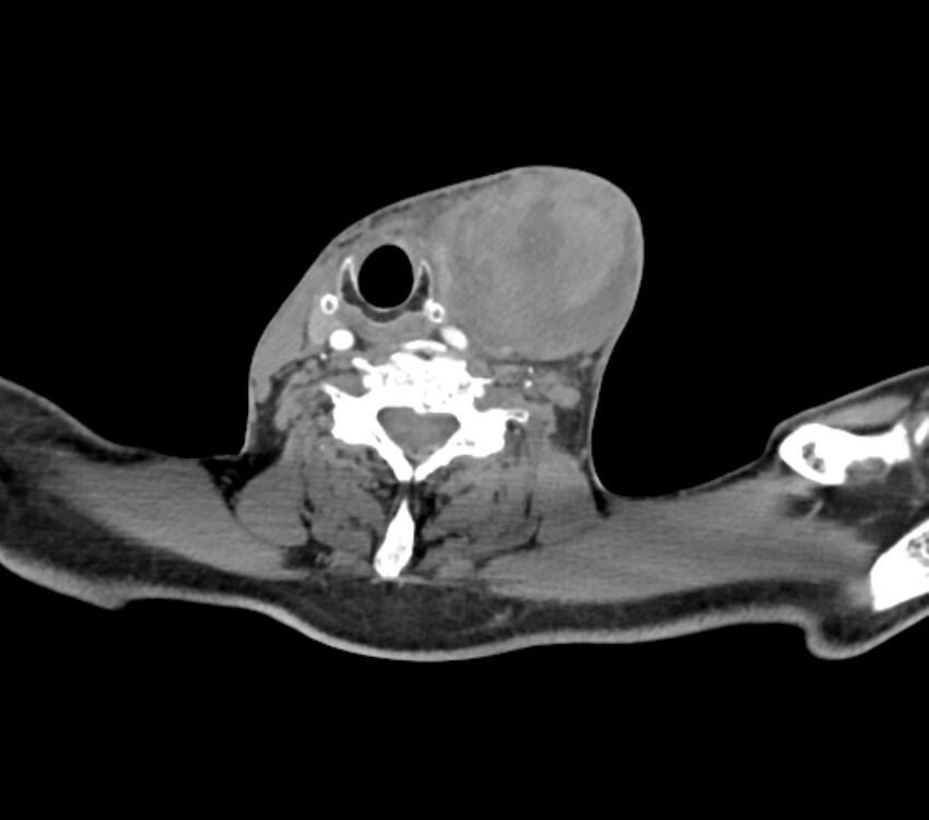 Carotid artery pseudoaneurysm (Radiopaedia 84030-99259 C 56).jpg