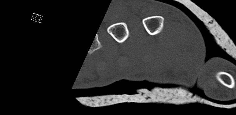 File:Carpal fractures (smart watch impaction) (Radiopaedia 55844-62430 Axial bone window 73).jpg