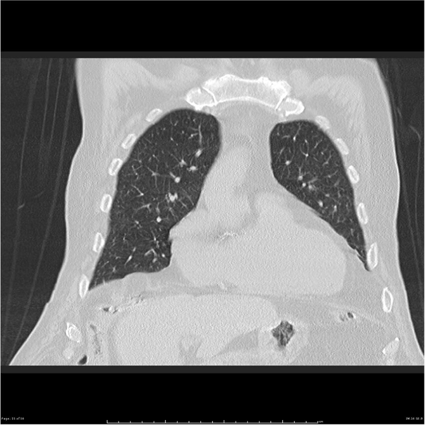 Cavitating left lower lobe lesion - squamous cell lung cancer (Radiopaedia 27749-28176 Coronal lung window 15).jpg